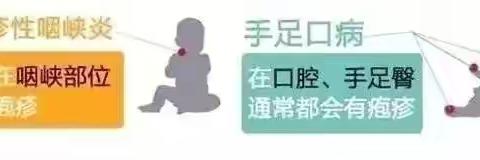 娇娇老师温馨提示家长：关于手足口病与疱疹性咽峡炎高发期的注意事项
