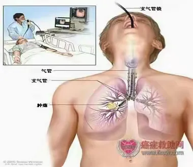 纤维支气管镜肺泡灌洗术