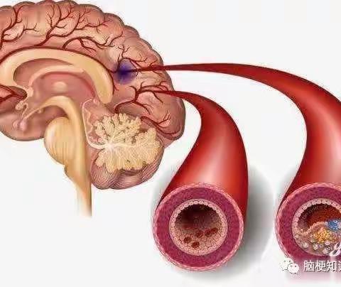 脑梗的常见类型