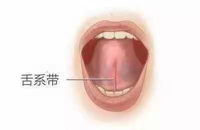 儿童舌系带过短的症状
