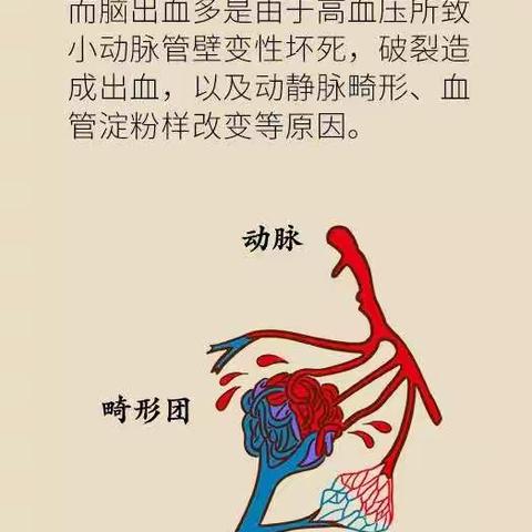 80%的脑出血与这个常见疾病有关，发现这三个症状要尽快就医！