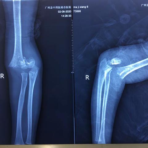 6岁患儿肱骨髁上骨折Gartlnd 3型骨折，行切开复位内固定术！