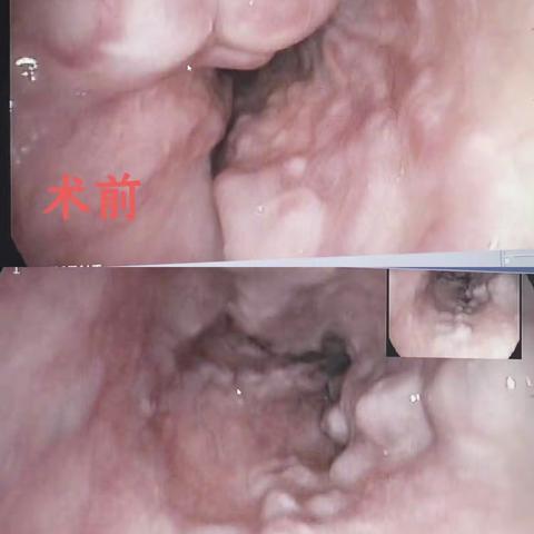 食管胃底静脉曲张内镜治疗，清徐县人民医院值得信赖！