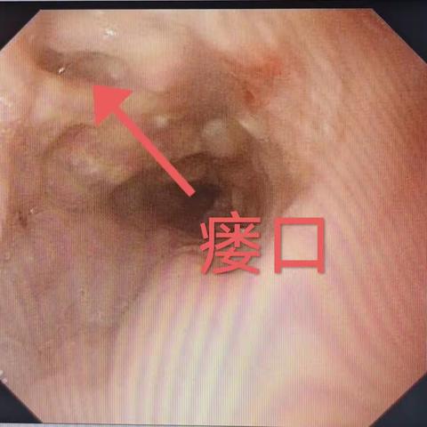 清徐县人民医院内镜室又完成一例食管支架植入术