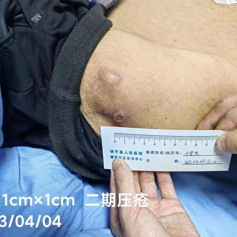 压疮案例追踪
