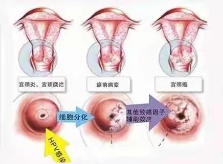 预防宫颈癌:到底是HPV还是TCT靠谱