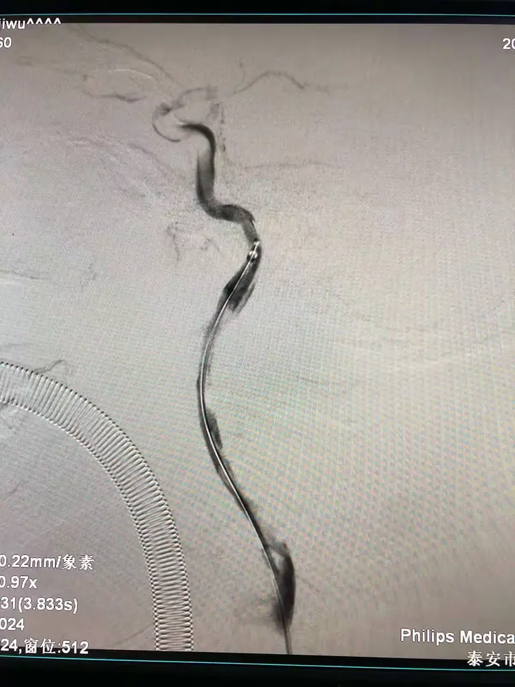 27通过闭塞段,将rebar-27送至右侧大脑中动脉上干