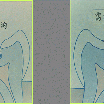 窝沟封闭   给孩子的牙齿穿上防护衣