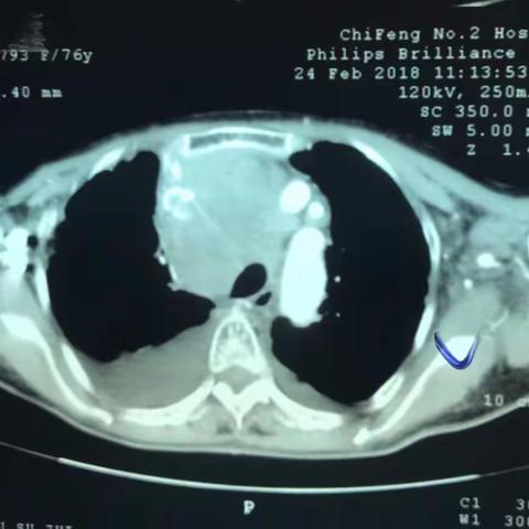 广泛期小细胞肺癌合并重度上腔静脉综合征的治疗   崔荟楠 赤峰市第二医院 肿瘤科
