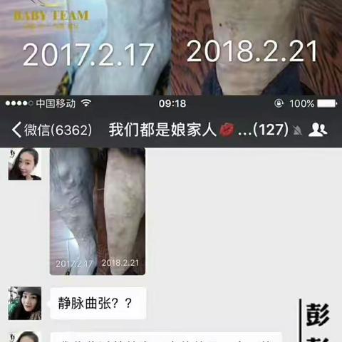 复合果汁之静脉曲张反馈案例