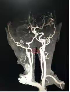 闽东医院神经内科近日取栓一例病人通报