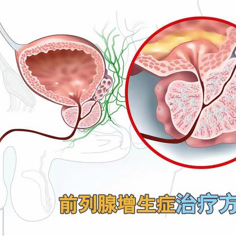 省内领先！127.6克巨大增生前列腺，钬激光成功剜除！