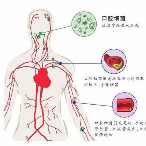 口腔健康与心、脑血管疾病