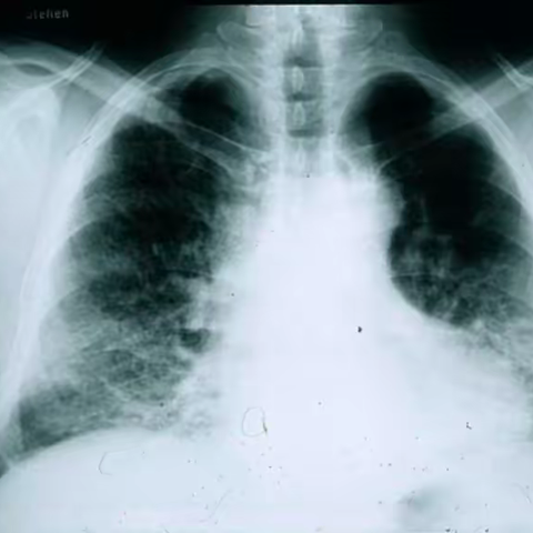 干燥综合症伴肺间质病变饮食注意事项
