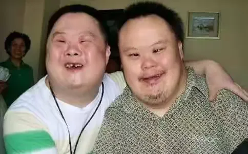 先天愚型(又称唐氏综合症、21-三体综合症