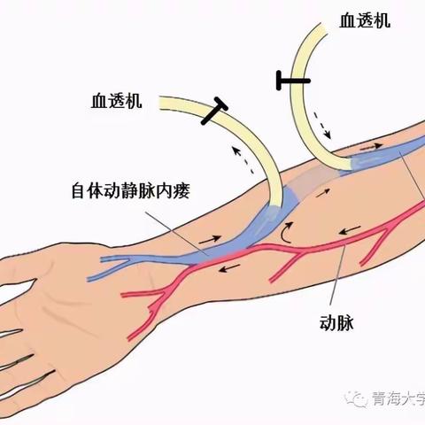 透析患者内瘘的日常维护