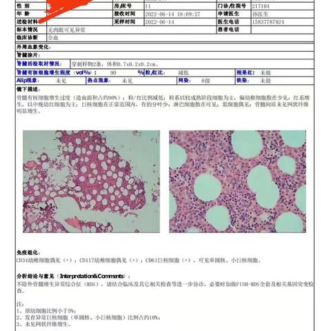 贫血无小事---骨髓增生异常综合征