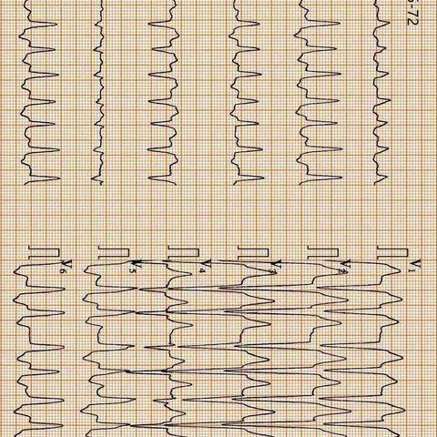 快速房颤，伴完全性左束支传导阻滞