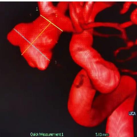 今日主刀不规则动脉瘤栓塞