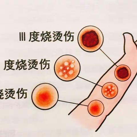 烧烫伤该如何正确处理呢？