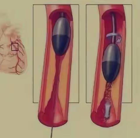 血管里开隧道、打开生命通道——冠状动脉旋磨术