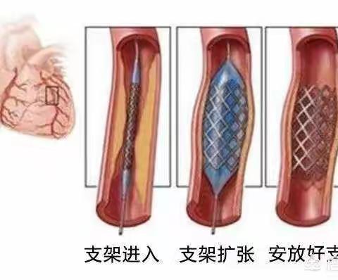 浅析冠状动脉支架植入术操作编码