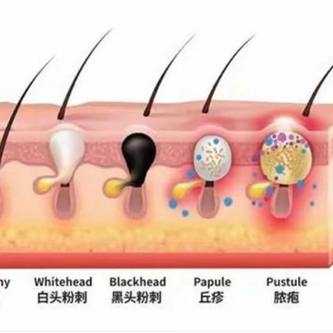 中医治疗寻常痤疮