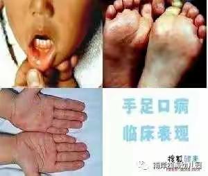 四海幼儿园保健知识-4种常见的秋季疾病预防