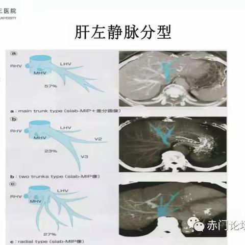 肝静脉的解剖