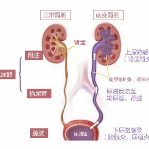 康复二科健康教育小课堂——神经源性膀胱的康复护理训练技术