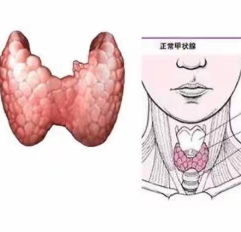 守住美丽的蝴蝶——甲状腺微波消融术