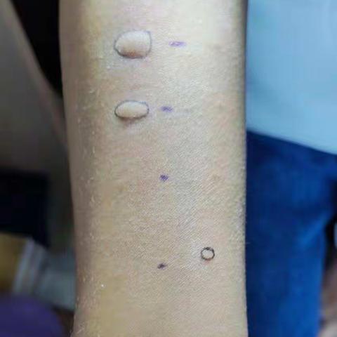 5月，17针，景景终于摆脱过敏了！