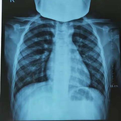 反复咳喘为哪般？