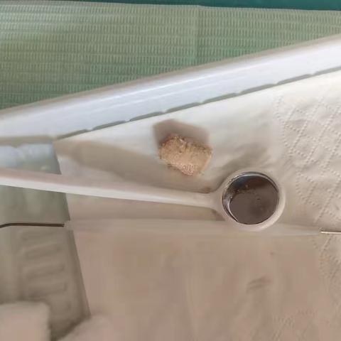 保定市第四中心医院口腔科收治大块牙结石致口腔大面积溃疡影响发音、进食患者一例
