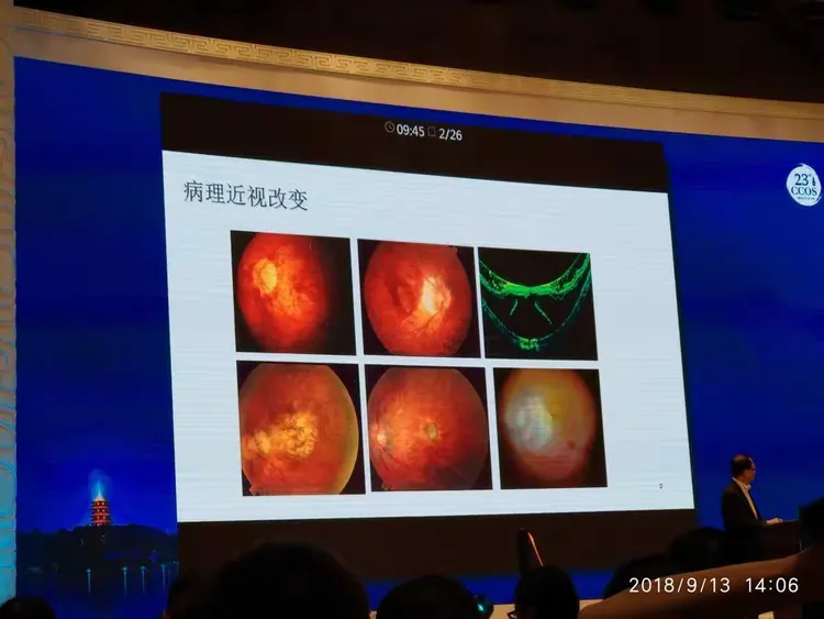 高度近视眼底病专题