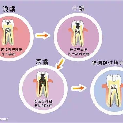 龋齿的治疗