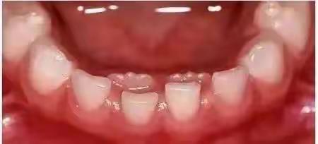 为什么新牙萌出，旧牙不掉？