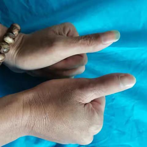 脚趾”变“拇指” 全形再造完美修复外观与功能