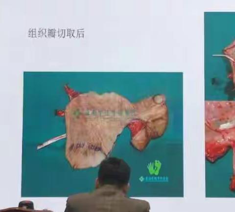 【手外科典型案例分享】我院手外科丁治红主任受邀参加全国再植再造研讨会