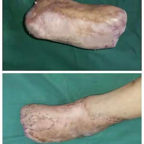 “真皮高定”——全足脱套伤的移植修复之路