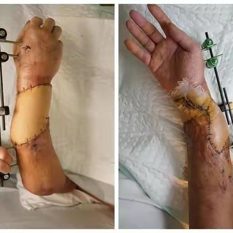 手臂创伤术后骨端坏死合并严重感染 保肢or截肢？