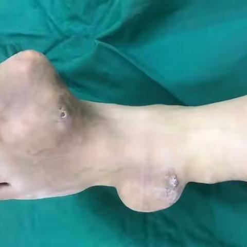 胡吃海喝的你看过来→ 30岁小伙患痛风十年 被鸡蛋大痛风石“绊手绊脚”