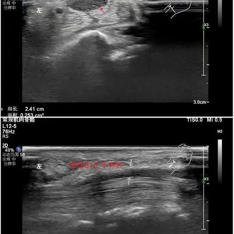 肌骨超声知多少？---我院超声科开展肌骨超声纪实