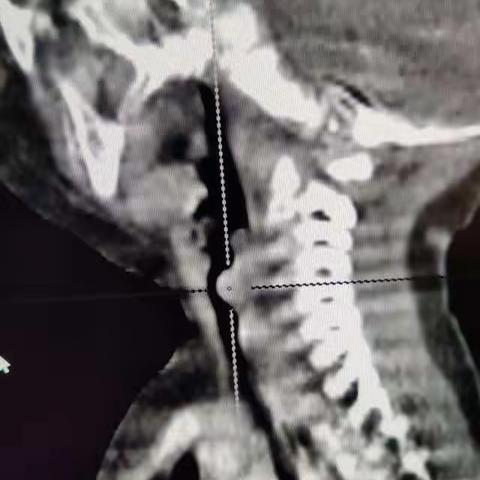 我院第一例声门下血管瘤成功救治