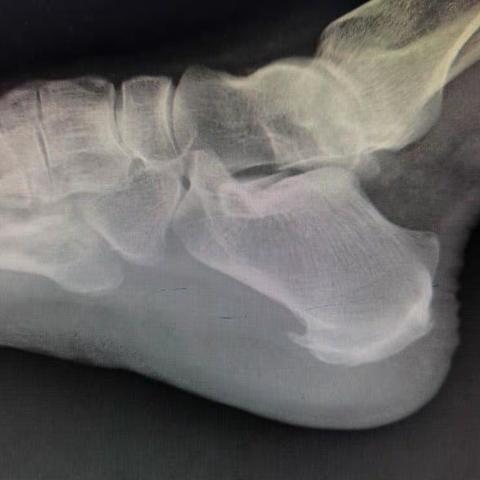 跟骨骨刺微创手术：关节镜下切除术