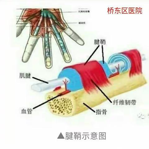 特色小针刀治疗狭窄行腱鞘炎，简单，无痛，花费少，恢复快治愈率高