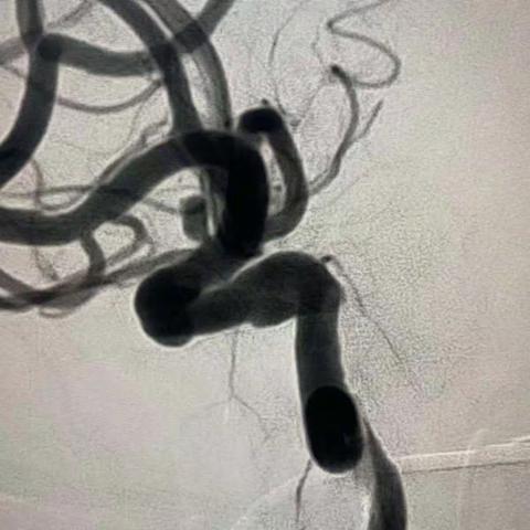 齐忠文 男 62岁 右侧颈内动脉C6段动脉瘤 栓塞术后