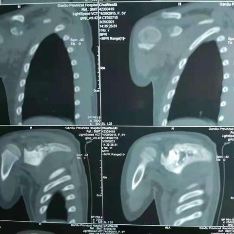 甘肃省人民医院骨软科诊治儿童肩胛骨尤文肉瘤一例