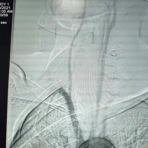 外伤性颈动脉急性闭塞复合手术再通一例-----一波三折，心跳的感觉