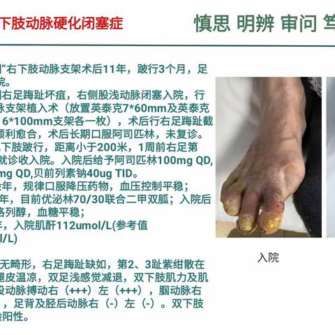 右侧股浅动脉支架内再闭塞，保护伞下飞利浦激光消融结合药涂球囊扩张个案报道